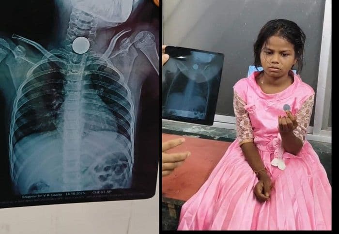 बच्ची के गले में फंसा दो रुपये का सिक्का,डॉक्टर ने बचाई जान